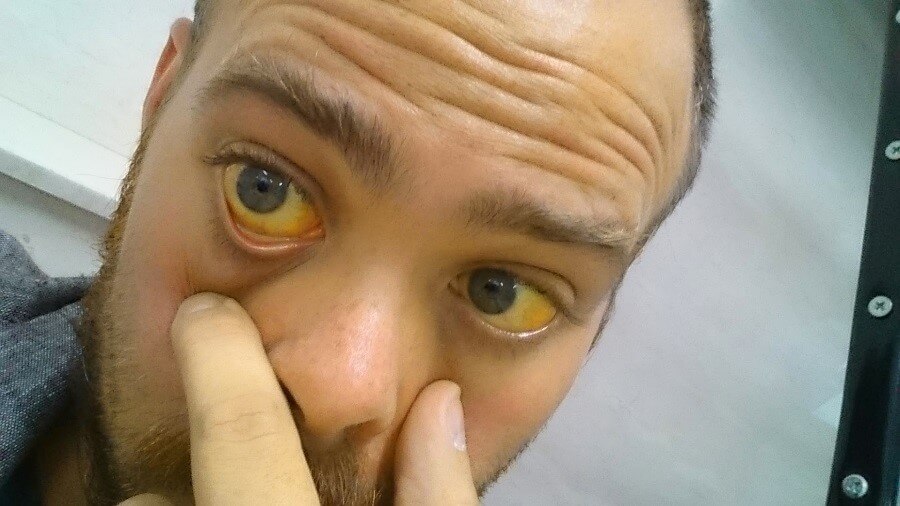 زرد شدن چشم‎ها در اثر متاستاز سرطان معده به کبد