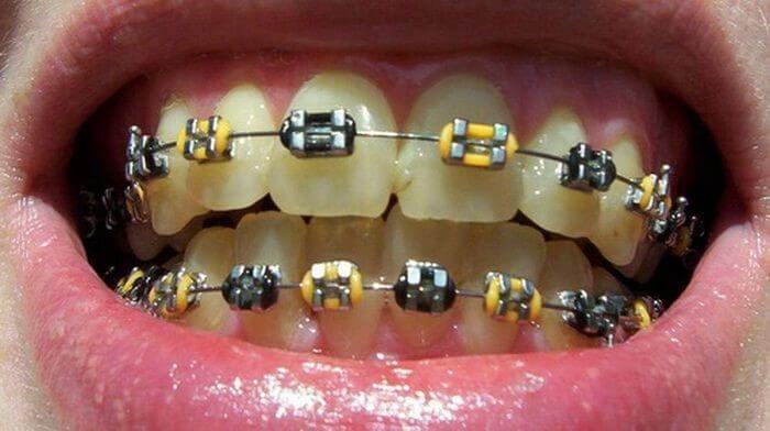 استفاده از براکت زرد رنگ برای ارتودنسی دندان یک نوجوان