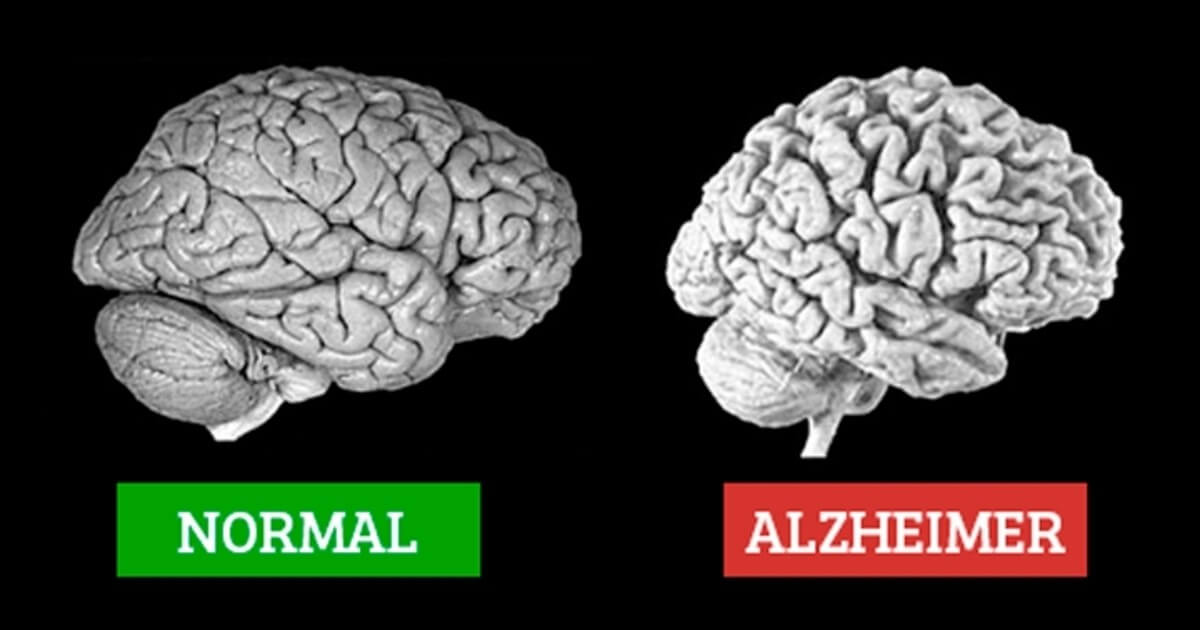 تاثیر پیشرفت آلزایمر بر تحلیل سلول‌های مغزی