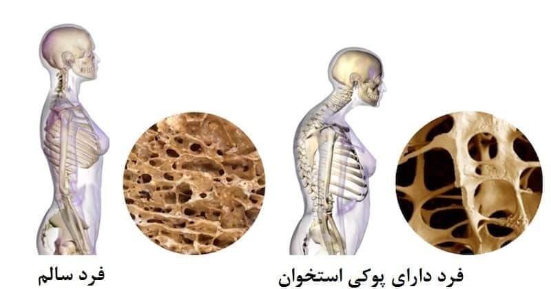 مقایسه بافت استخوانی فرد سالم و مبتلا به استئوپروز