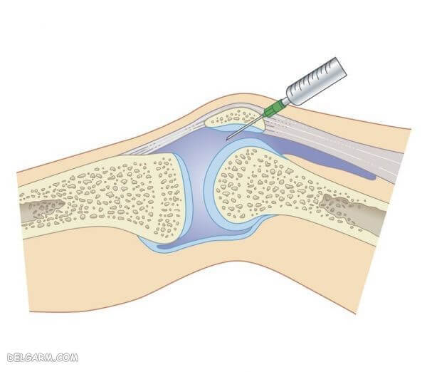 نمونه برداری از مایع مفصلی به وسیله سرنگ برای تشخیص نقرس