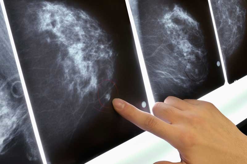 شکل توده سرطان پستان