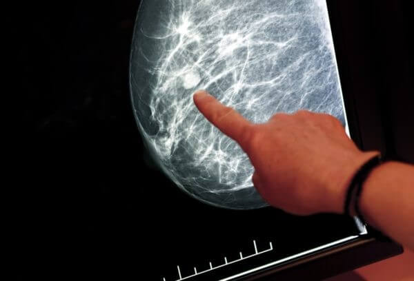شناسایی توده موجود در پستان به کمک ماموگرافی