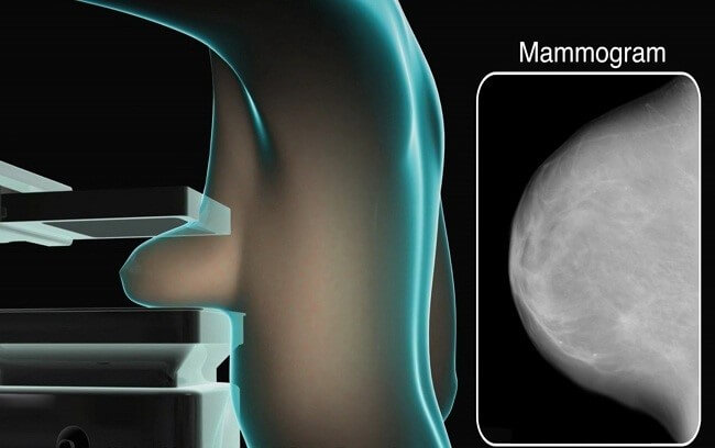 نحوه قرار گرفتن پستان در دستگاه ماموگرافی