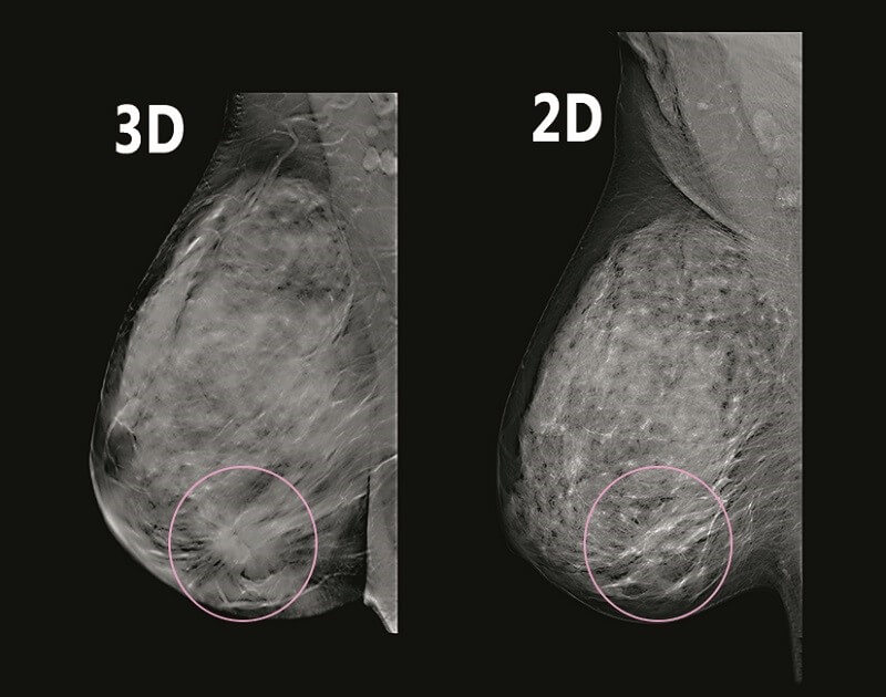 تفاوت کیفیت تصویر دریافت شده از ماموگرافی عادی و سه بعدی
