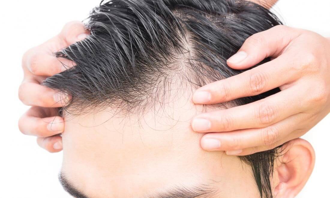 ریزش مو در اثر کمبود کلسیم