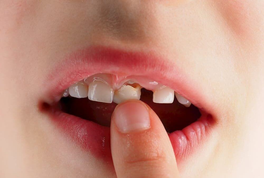 لق شدن و افتادن دندان کودک به دلیل کمبود کلسیم