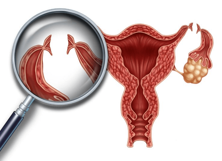 انجام عمل توبکتومی برای جلوگیری از بارداری
