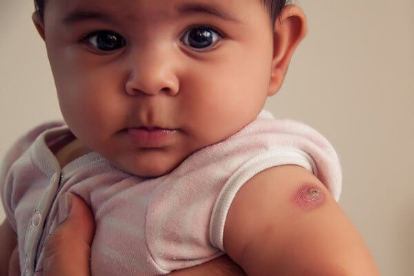 بروز التهاب در محل تزریق واکسن نوزاد
