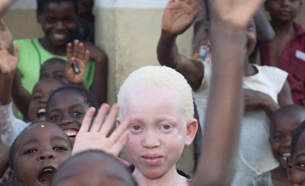 یک کودک آلبینو از نژاد سیاه پوست