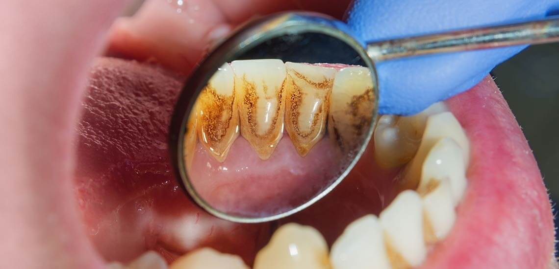 درمان التهاب لثه ناشی از پلاک دندانی