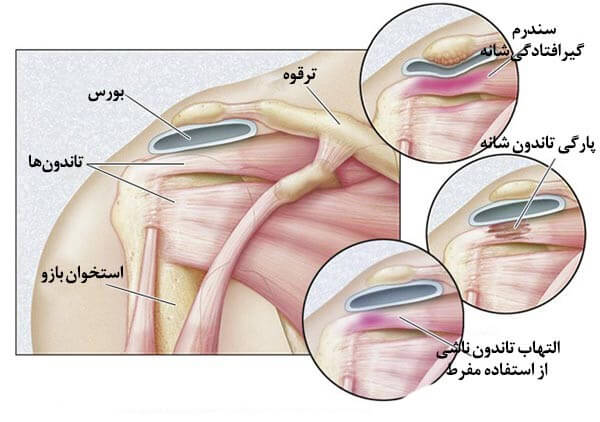 علل ایجاد درد در بازوی راست