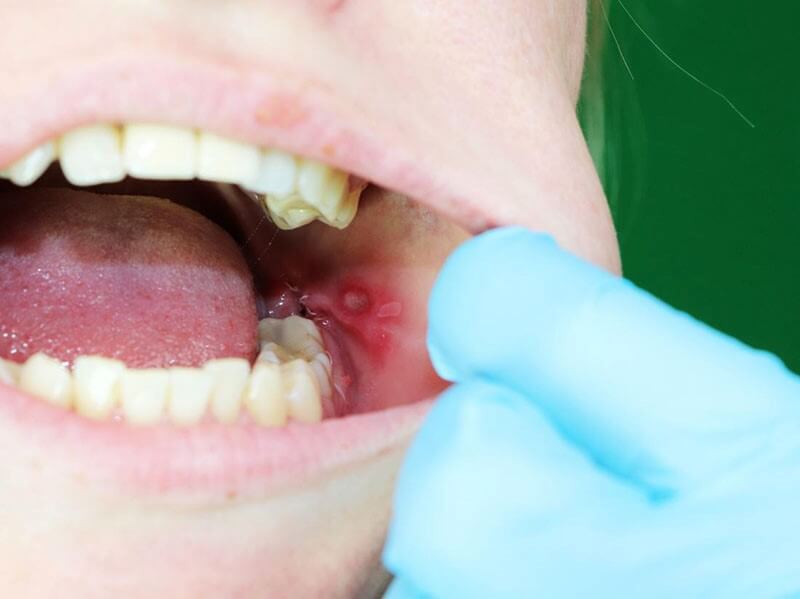 زخم‌های دهانی ناشی از لوپوس