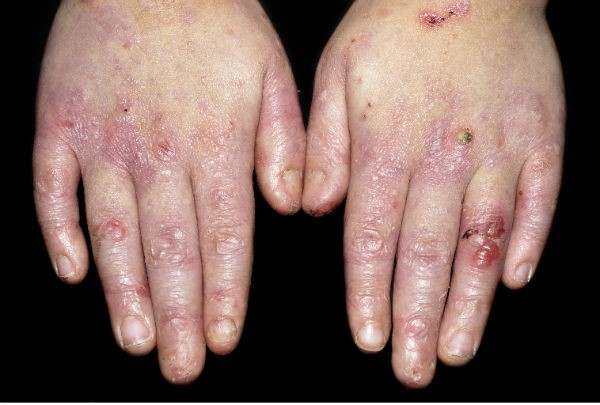 علائم بیماری پروانه ای در دست