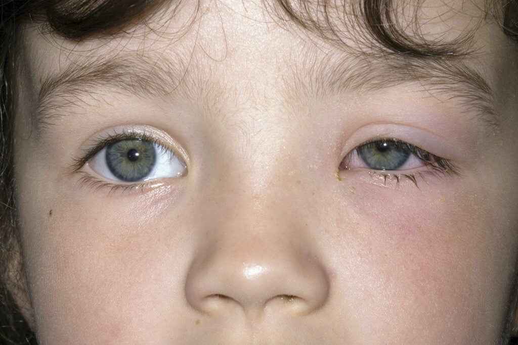دلایل تنبلی چشم در کودکان