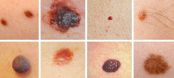 ملانوما خطرناک‌‏ترین نوع سرطان پوست