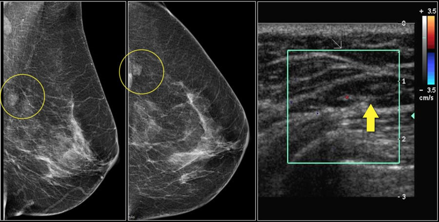 انواع ماموگرافی