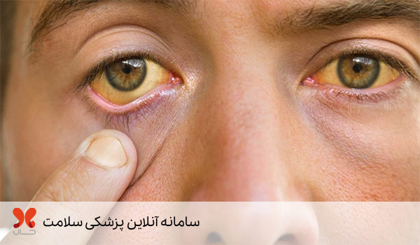 نشانه‌های نارسایی کبد