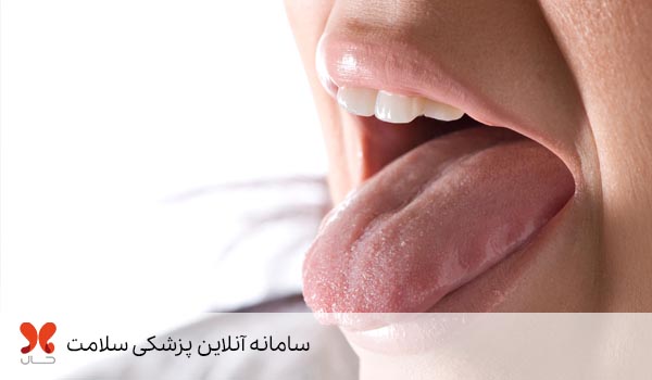 درمان سوختگی دهان