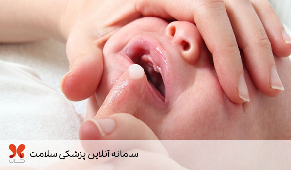 درمان برفک دهان نوزاد